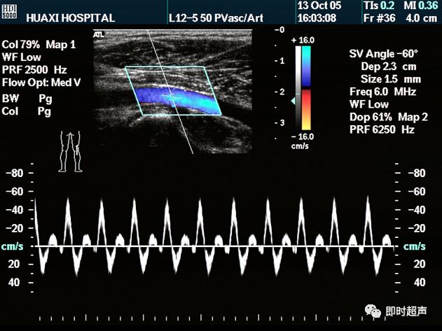 肺静脉频谱图片