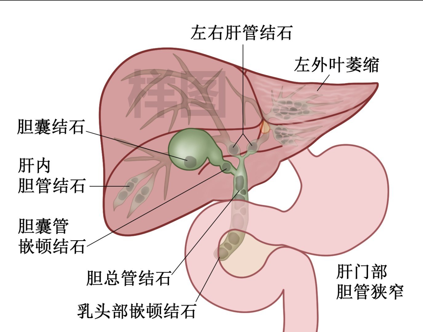 肝内胆管结石位置图图片