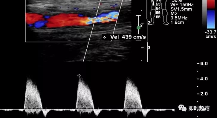 超声下肢血管解剖图谱图片