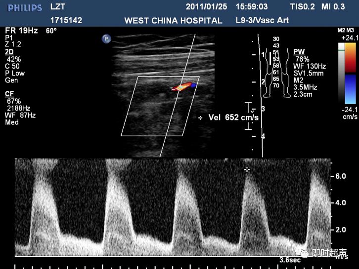 超声下肢血管解剖图谱图片