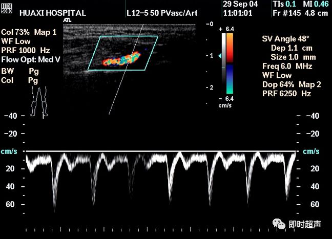 四肢多普勒血流图ABI图片