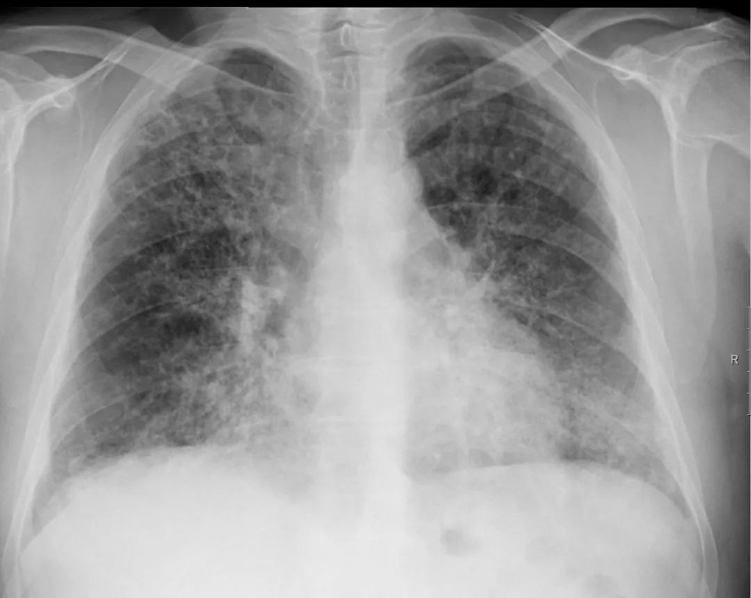 支气管肺炎胸片表现图图片