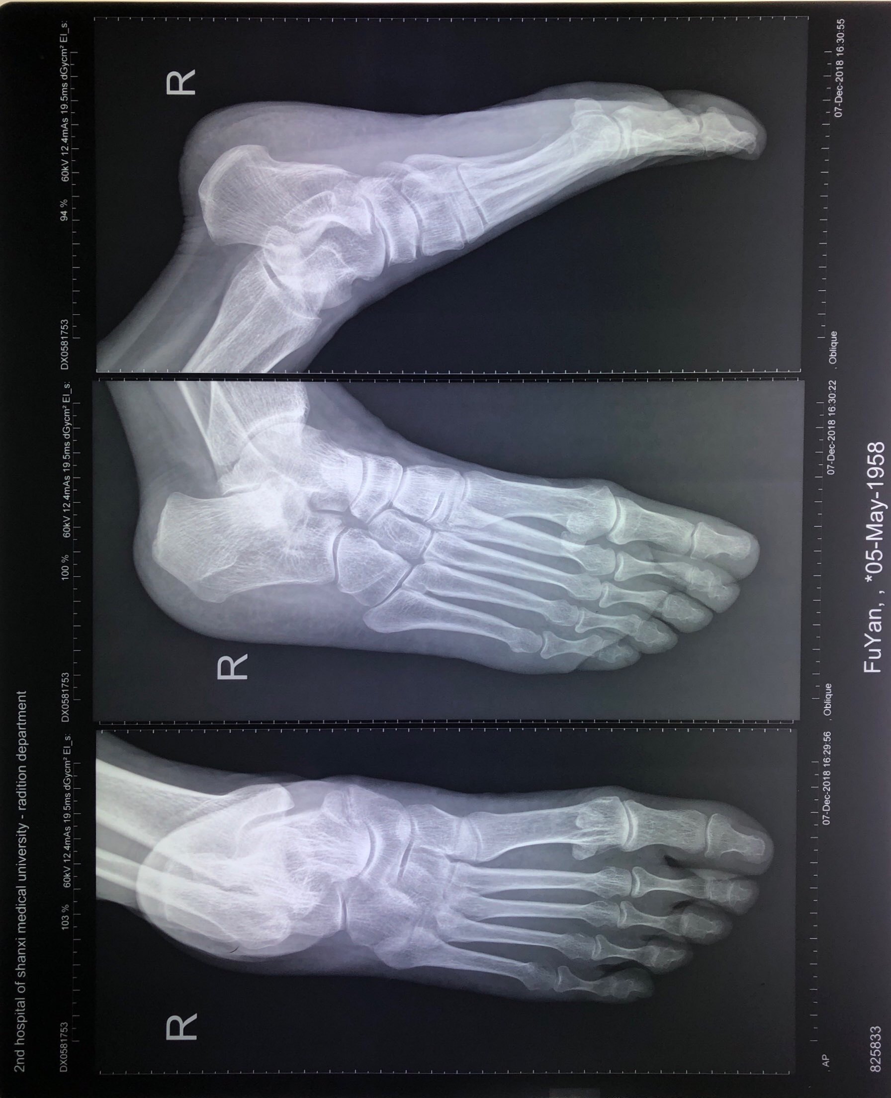 副舟骨胫后肌腱炎图片