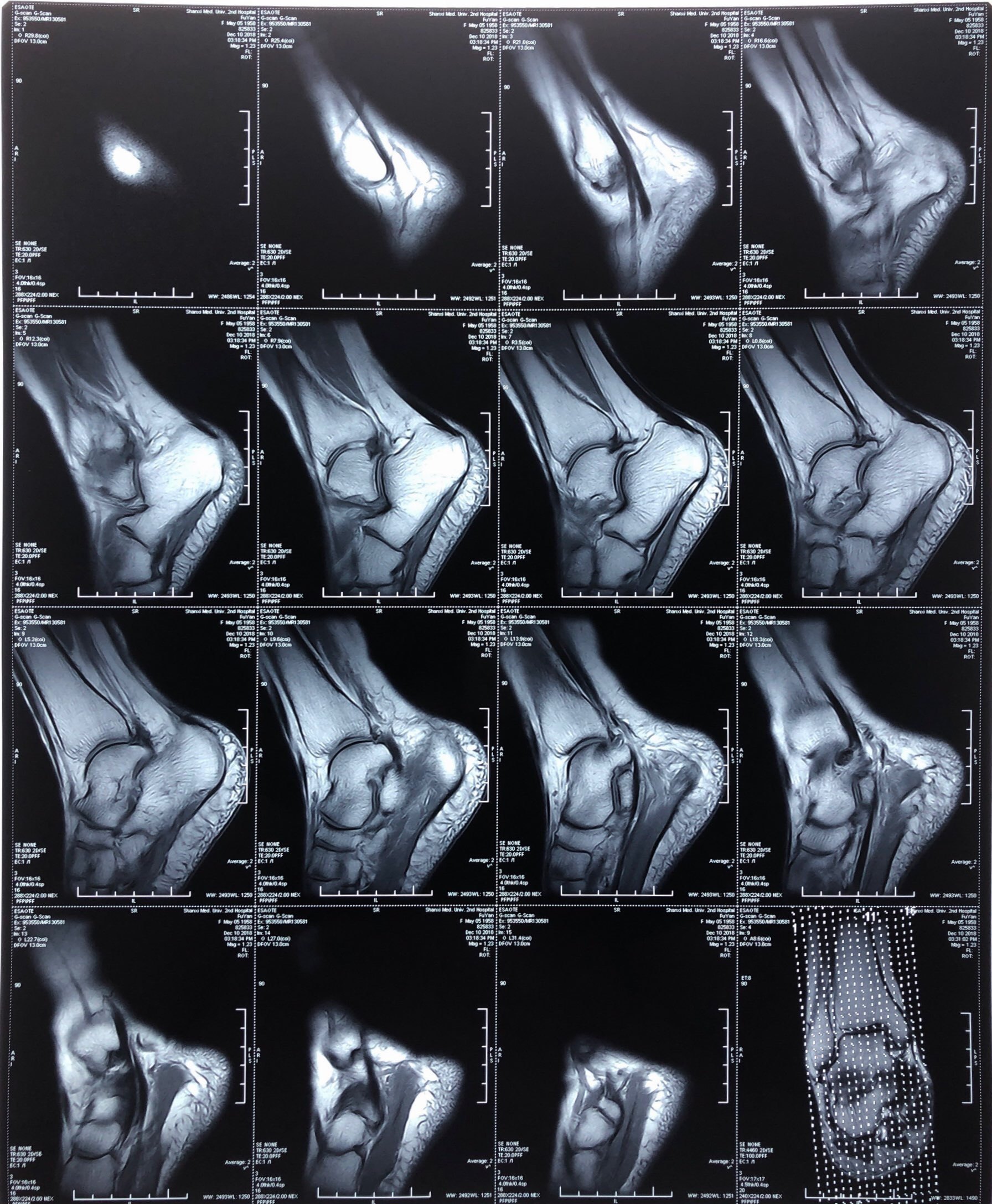 副舟骨胫后肌腱炎图片
