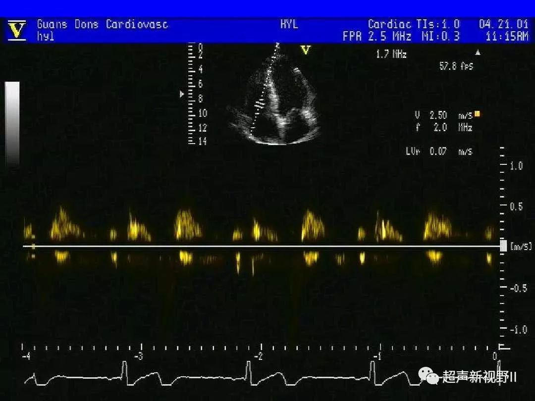 超声微课堂心脏超声标准切面及测量