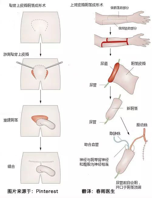 变性手术过程图图片