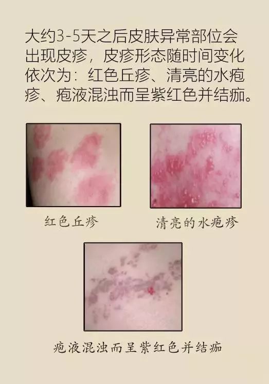 带状疱疹缠腰蛇后遗神经痛到底是怎么回事