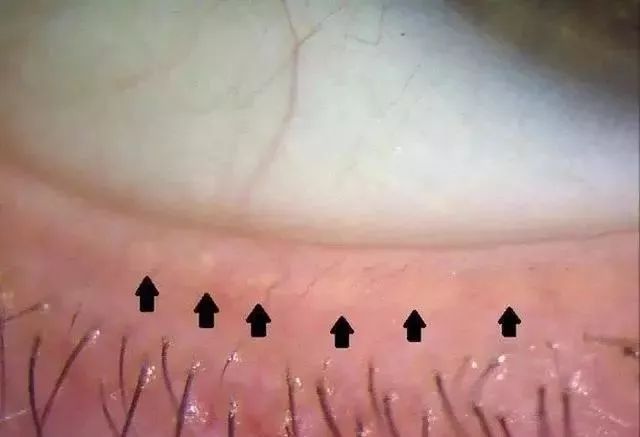 通常以睑板腺终末导管的阻塞和/ 或睑板腺分泌物质或量的改变为特征