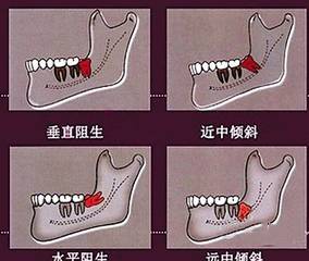 智齒因萌出位置不良,牙齒可能部分或全部被齦瓣覆蓋,加上位於口腔的最