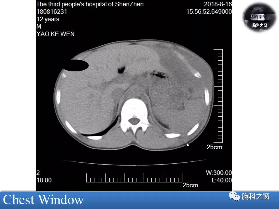 轮值病例208期纵膈胸壁胚胎性横纹肌肉瘤