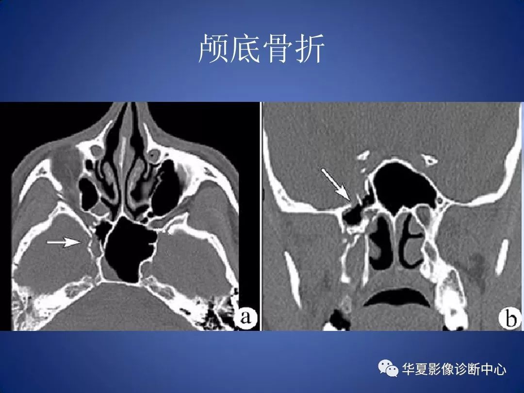 頭顱外傷急診ct診斷