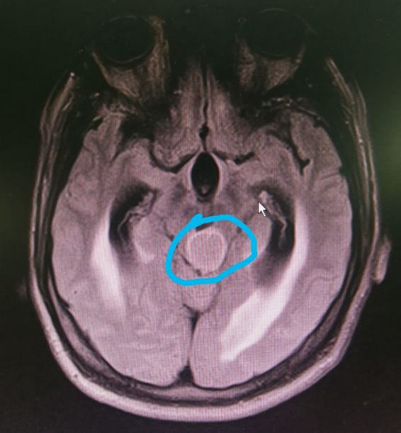案例神經內鏡下一站式解決松果體區腫瘤合併腦積水 (原創)_手術