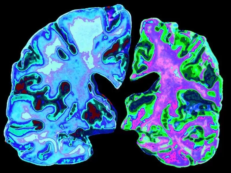 (左:70岁正常的大脑;右:70岁阿尔茨海默病患者的大脑)
