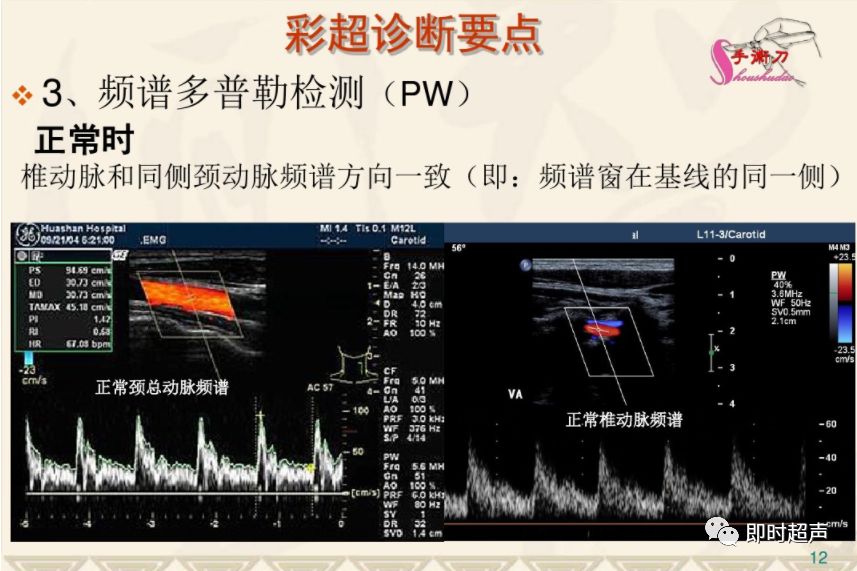 鎖骨下動脈盜血綜合徵