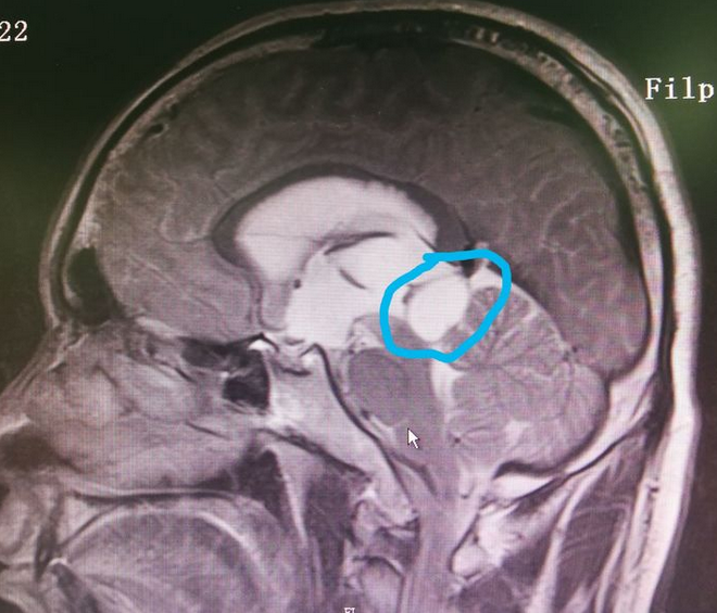 案例神經內鏡下一站式解決松果體區腫瘤合併腦積水 (原創)_手術