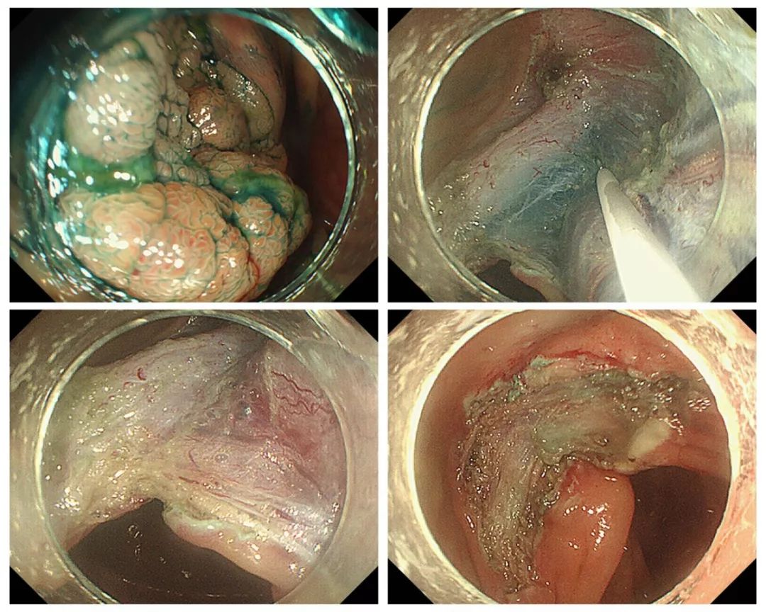 我院胃肠内科(内镜中心)张斌主任团队内镜下成功切除巨大升结肠侧向