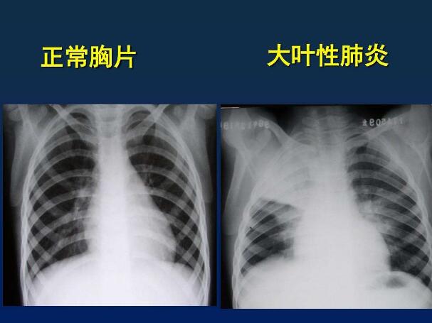 支气管肺炎胸片图片