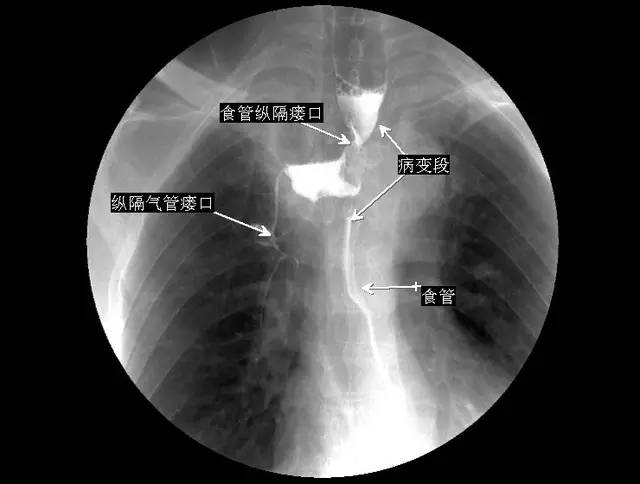 5 分钟读懂消化道造影_食管