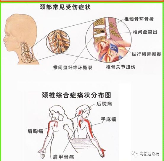 頸椎間盤突出症