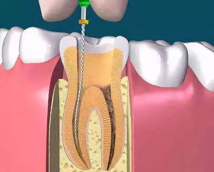 牙齿根管治疗图片步骤图片