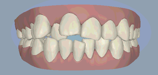 移动给牙齿一个外力牙齿正畸是医生通过矫治器牙齿正畸为什么要拔牙?