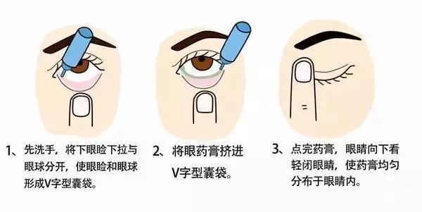 红霉素涂于眼睑内图解图片