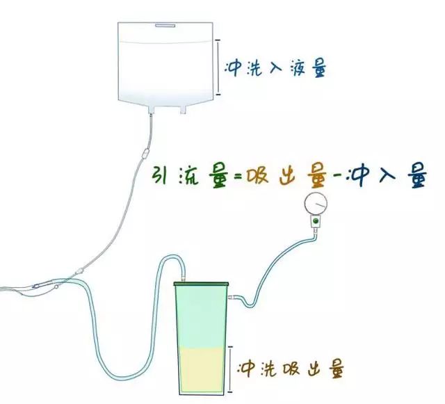 腹腔双套管冲洗示意图图片