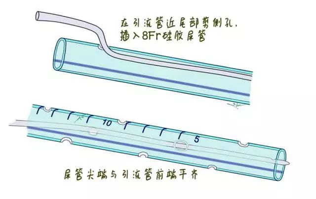 多图教你轻松搞定腹腔引流管冲洗