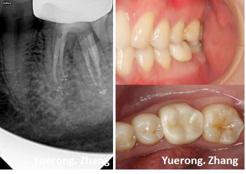 下颌第一磨牙根管治疗1例