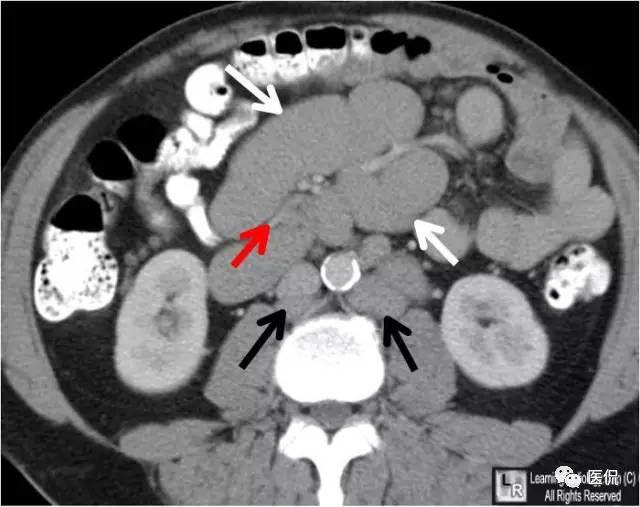 肠系膜淋巴结ct图片