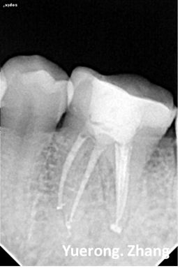 下颌第一磨牙根管治疗1例
