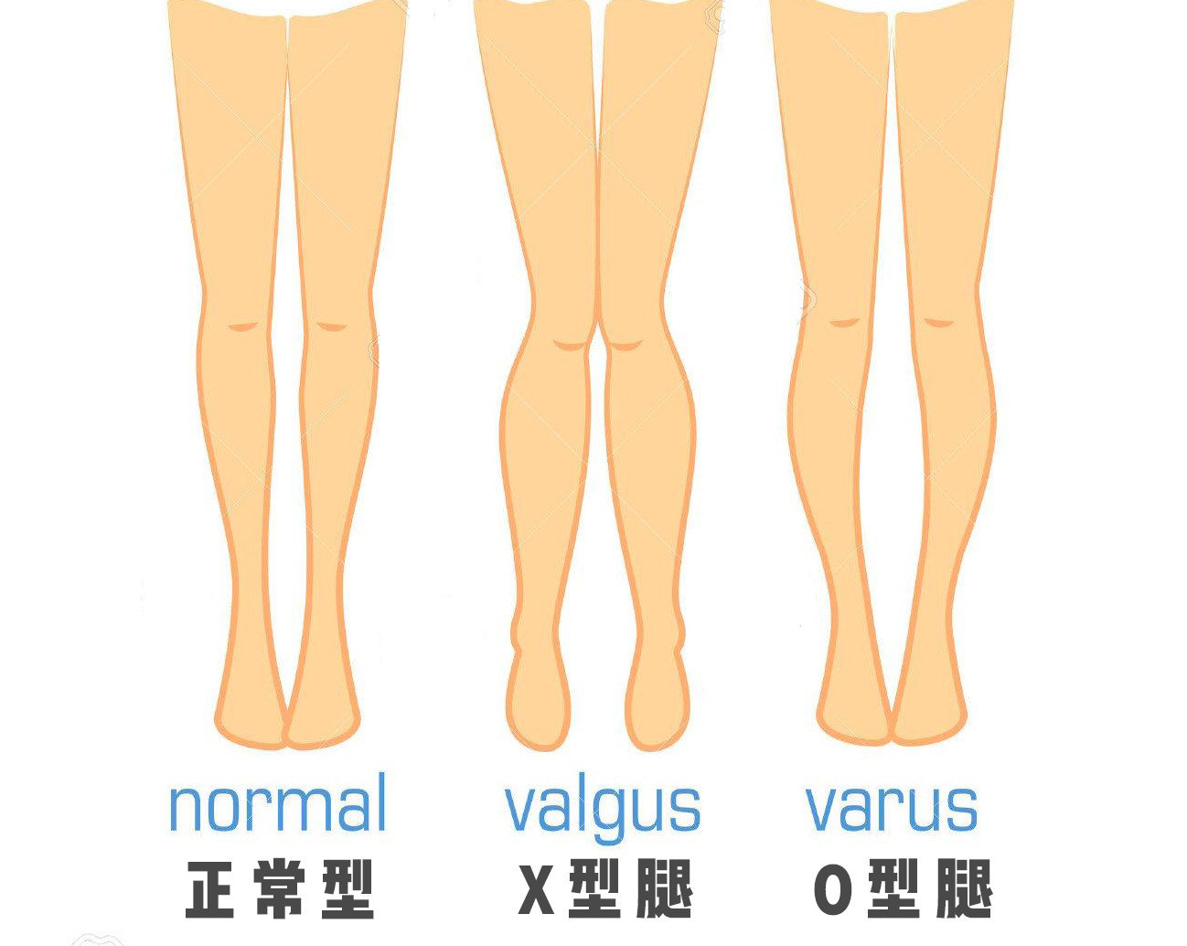 一,正常腿型如果自然站立的时候,双脚和膝盖能同时合拢,说明腿型是