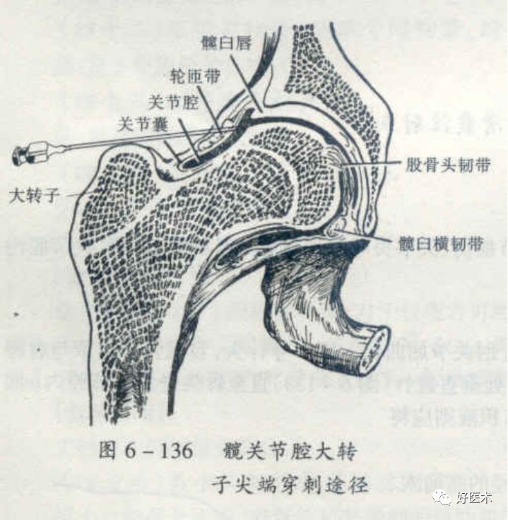 髋关节腔注射术定位图图片