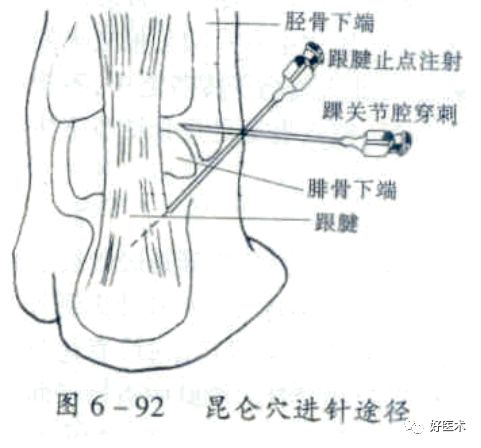 踝关节穿刺进针点图解图片