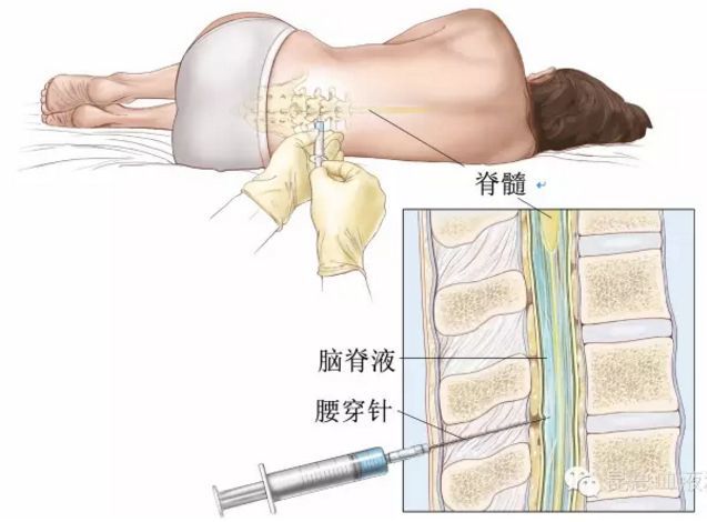 腰椎穿刺图片构造图解图片