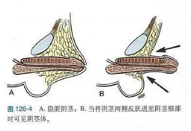 尿道下裂类型图解图片