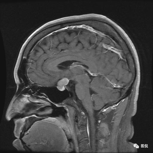 25岁因为这个鞍区占位已经头痛看不清东西了请诊断