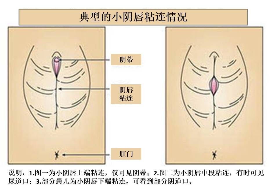 女性婴儿尿道口图片