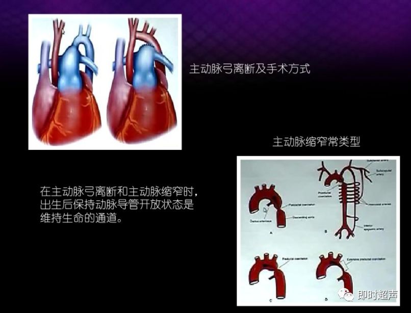 動脈導管未閉超聲診斷