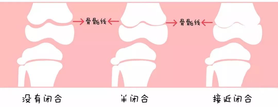 孩子的骨骼中有个部分叫作骨骺,这个东西在骨骼生长中至关重要