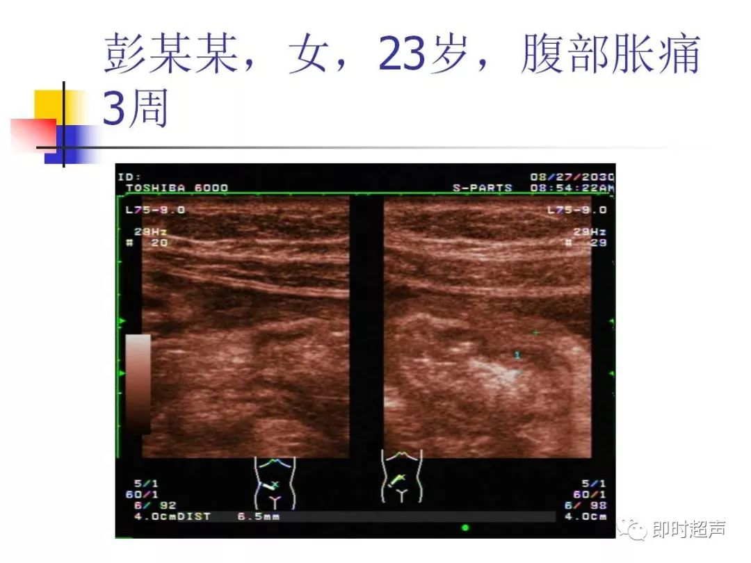 闌尾超聲掃差在急腹症中的應用