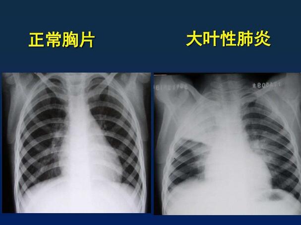 支气管肺炎胸片表现图图片