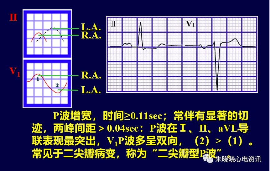 p波增宽图片