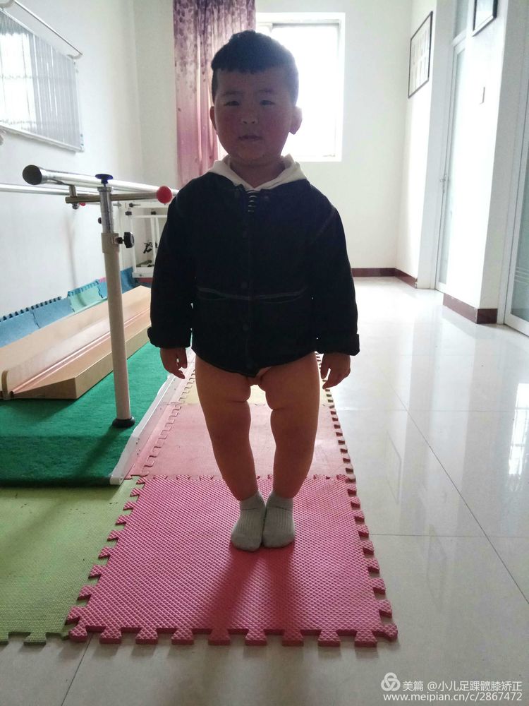 o型腿又名罗圈腿是一种常见的儿童足部畸形农村孩子家长一定要重视