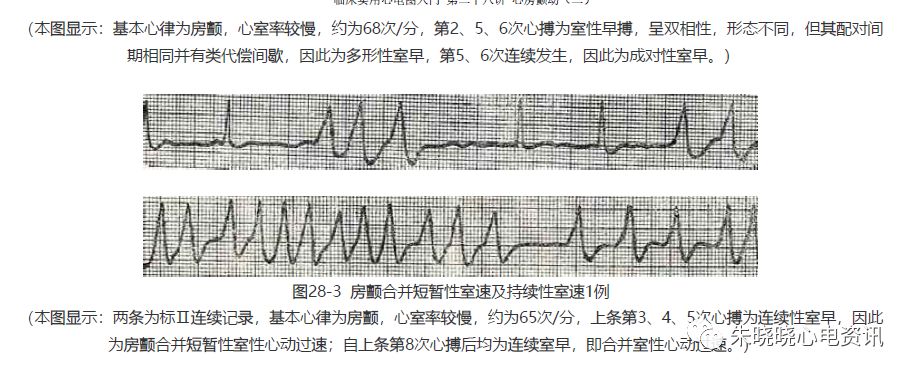临床实用心电图入门第二十八讲心房颤动二