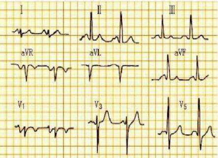 二尖瓣p波心电图图片图片