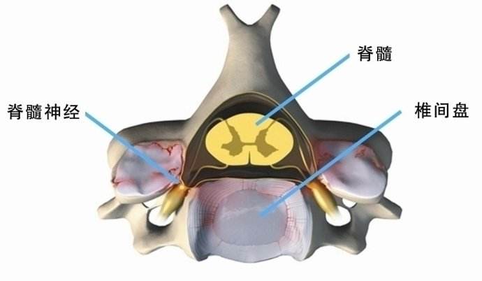 一個症狀就知道你椎間盤哪裡突出了