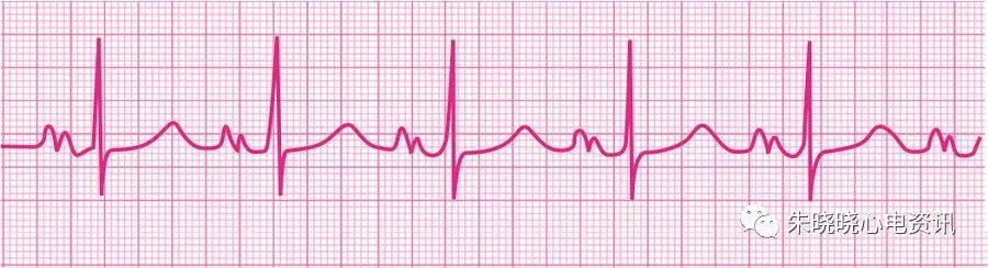 p波双向的心电图图片