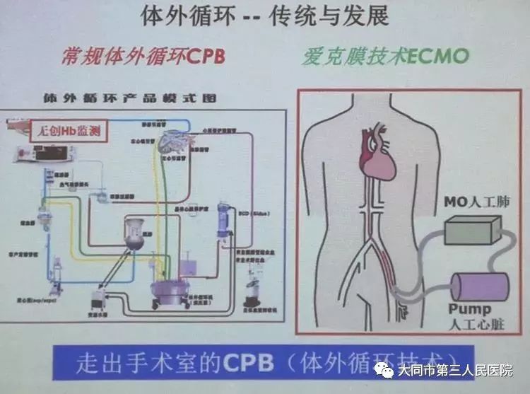 ecmo是走出心脏手术室的体外循环技术.