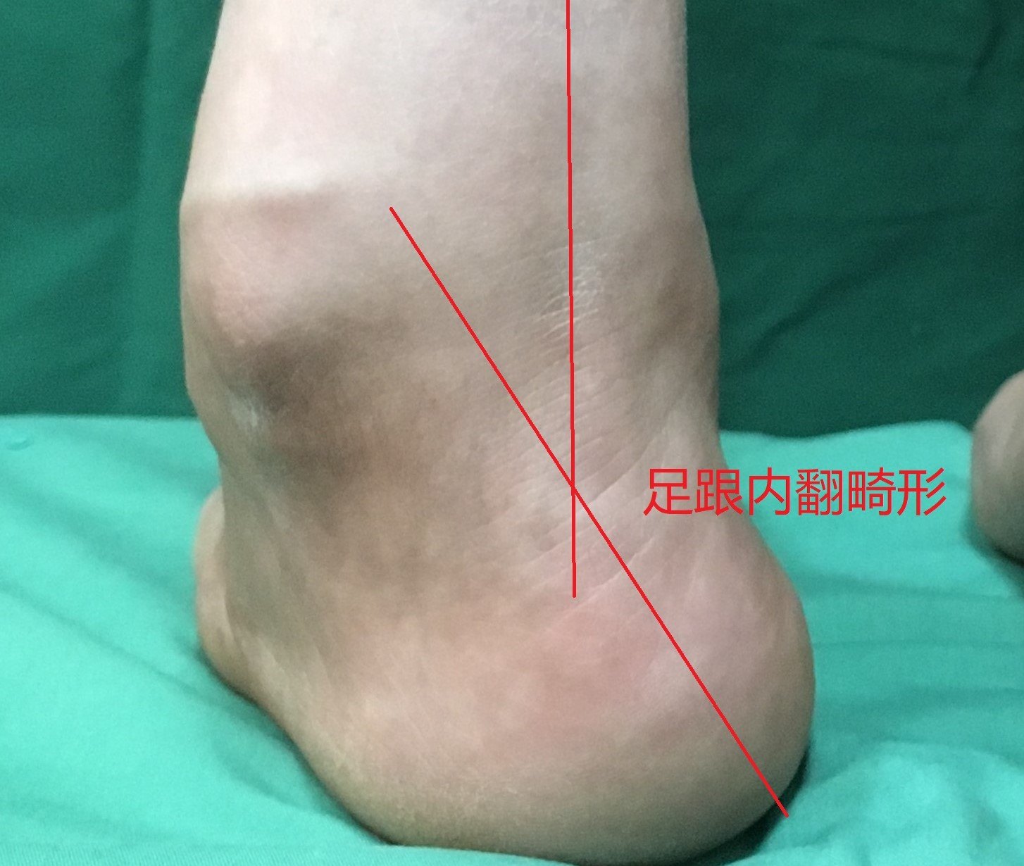 高弓足是指足弓异常增高,负重时足弓无法放平的足部畸形